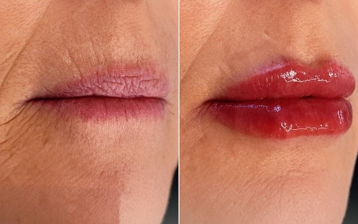 Antes e depois de tratamento labial na Clínica Renova