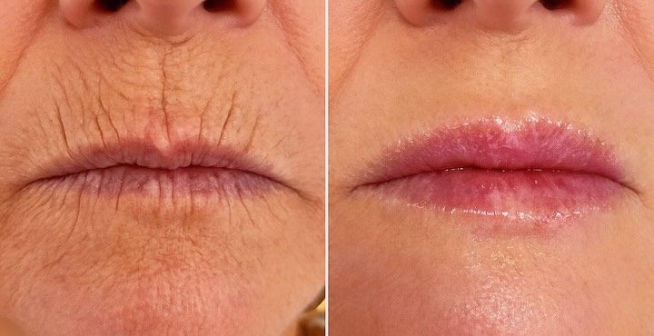 Antes e depois do Método Recode: linhas ao redor dos lábios suavizadas